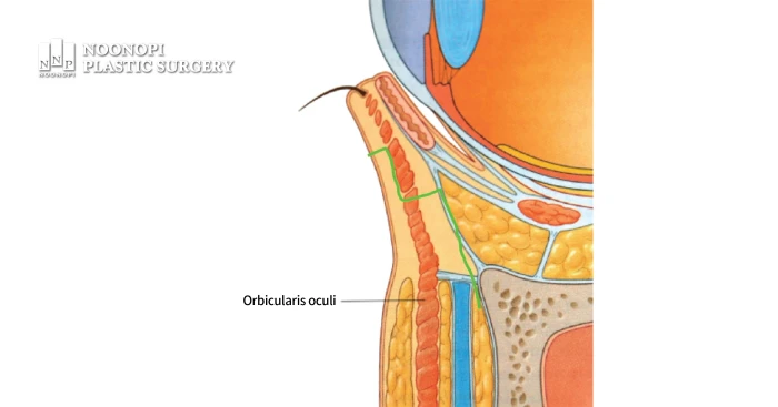 Illustration of the dissection process during lower lid surgery