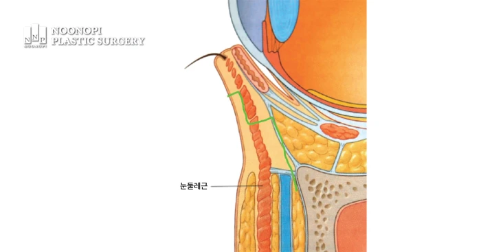 하안검수술 시행시 진행되는 박리 일러스트