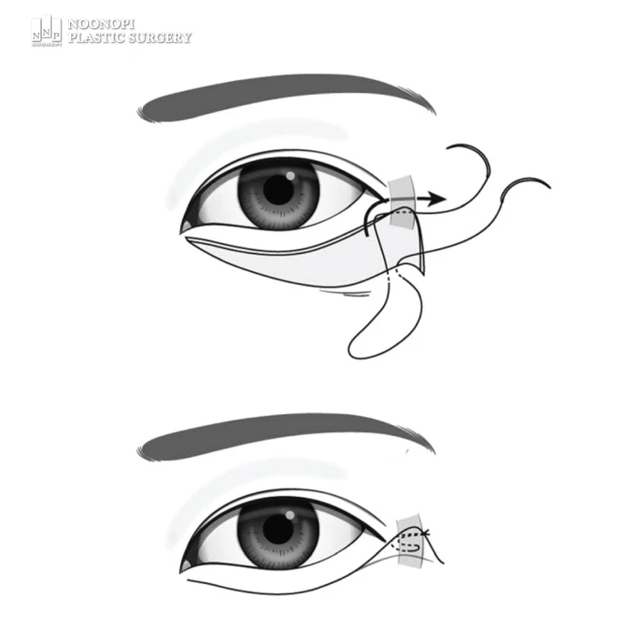 Orbicularis Oculi Muscle (OOM) suspension 논문 사진