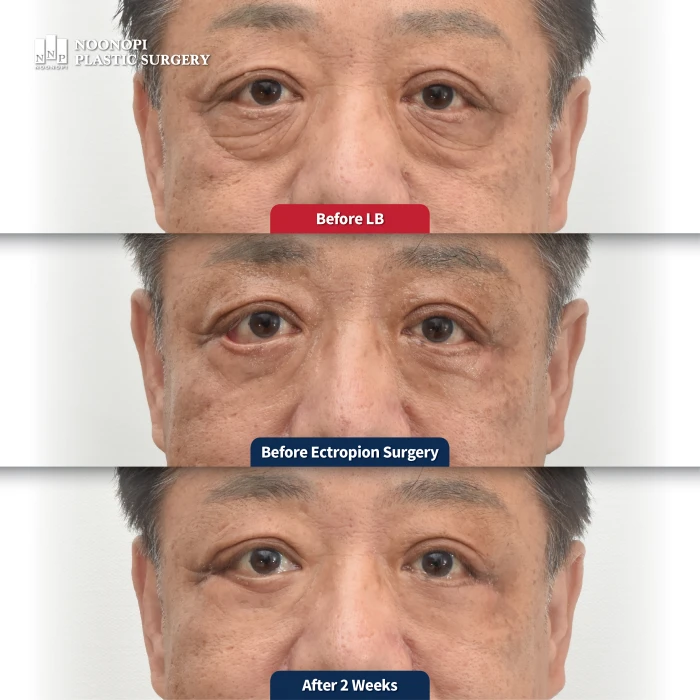 안검외반부작용을 외안각고정으로 치료한 전후