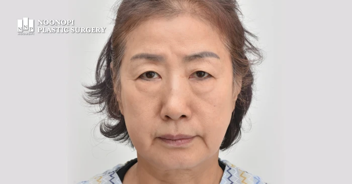 노화로 인해 눈꺼풀이 처지고 이마주름이 깊어진 처진 눈수술 전 모습