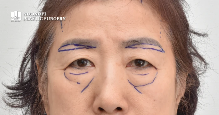 눈꺼풀처짐 개선을 위한 눈썹하거상술 디자인