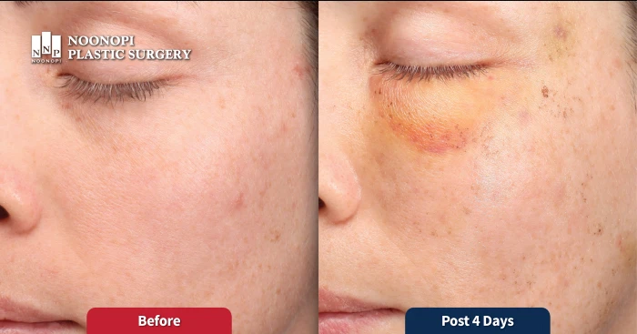 BBL laser treatment on Caucasian skin types