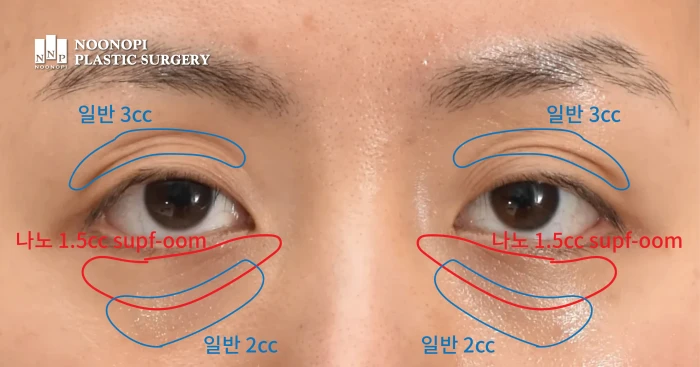 눈높이성형외과 지방이식 기록 일부로 눈 지방이식은 얼마나 주입해야하는지에 대한 insight를 제공하는 사진