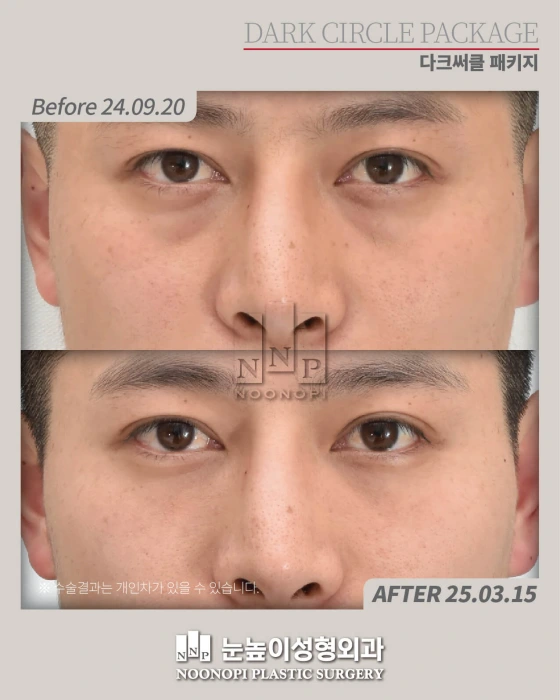 results of eye bag surgery along with laser