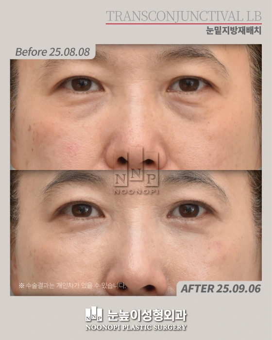 bags under eyes surgery results
