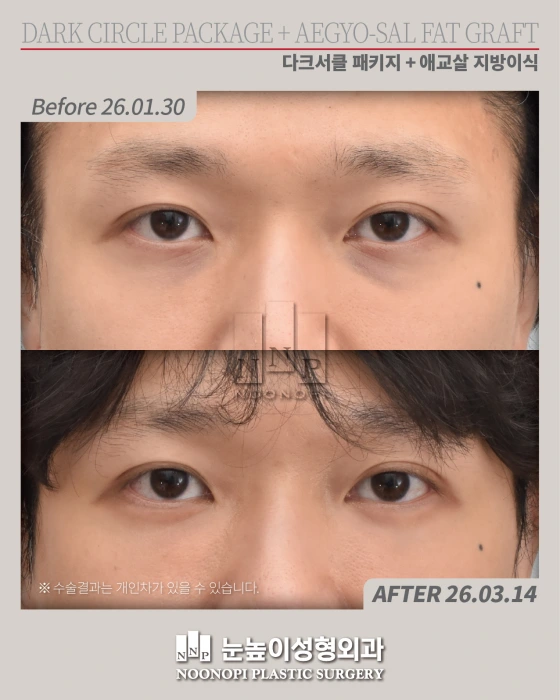 dark circle under eyes has been well treated along with aegyo-sal fat graft