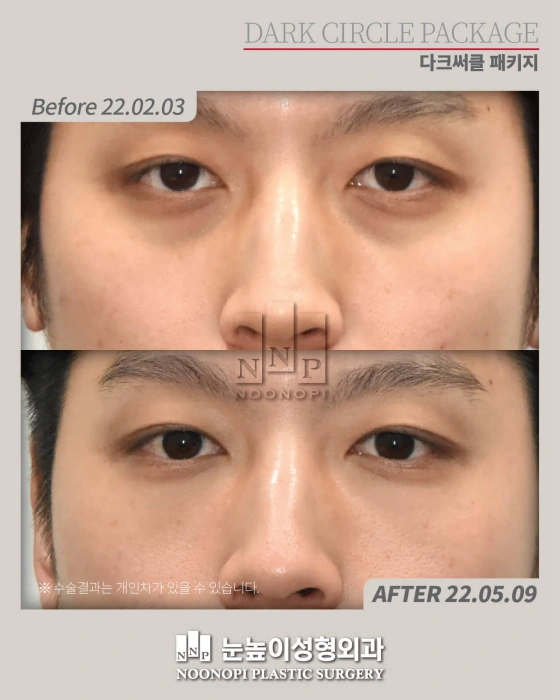 before and after of dark circle under eyes treatment