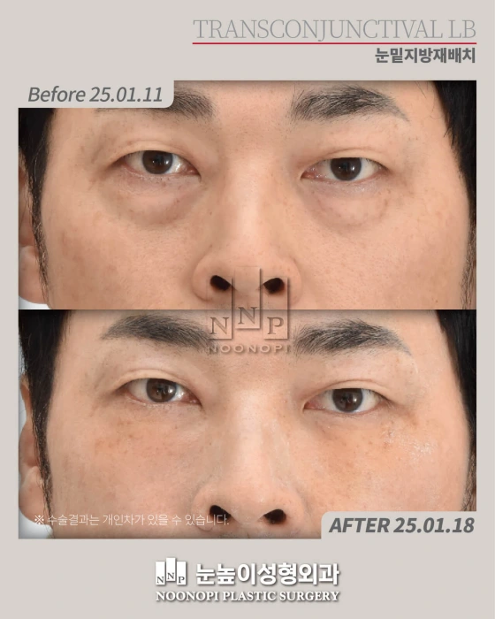 eyebags surgery