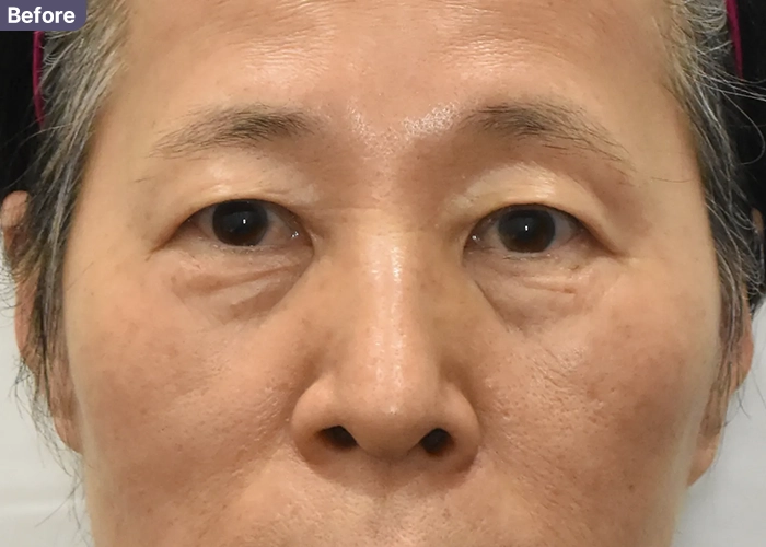 60대 하안검 수술 전 모습