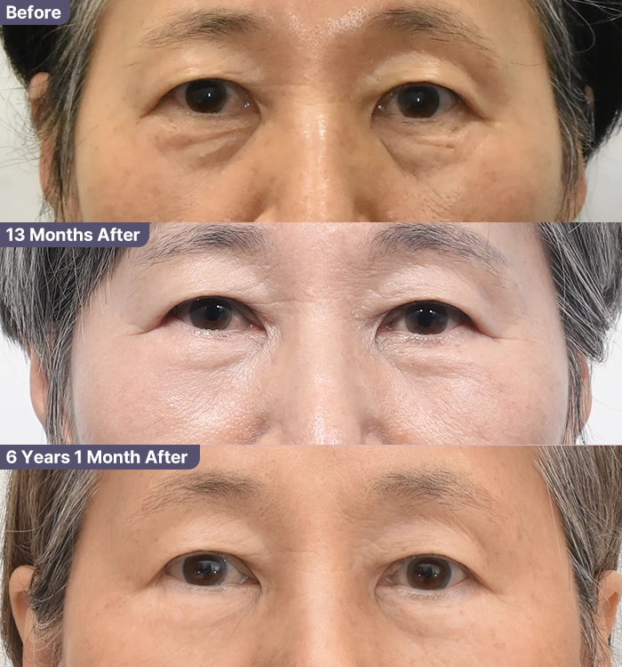 하안검수술 전- 13개월경과- 6년후 경과사진
